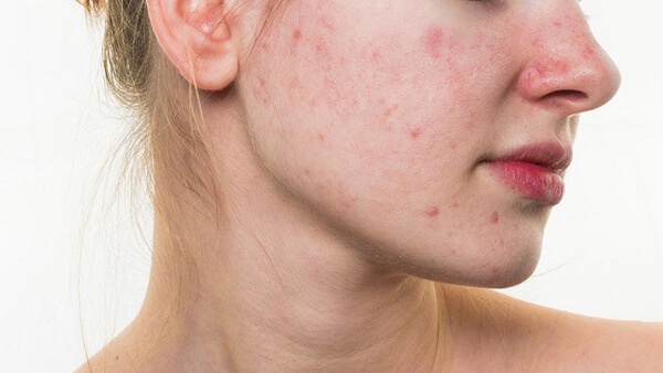 Mặt nổi đốm đỏ không ngứa: Nguyên nhân và cách xử lý