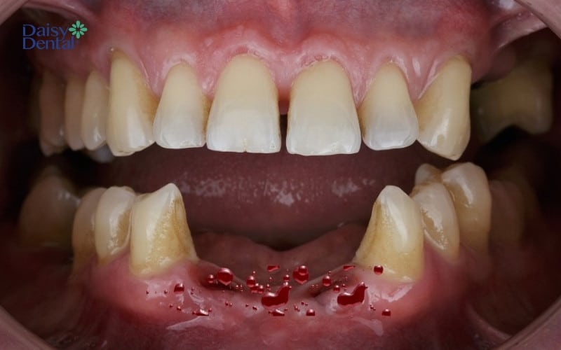 Mơ Bị Rụng Răng Chảy Máu: Điềm Báo Gì?