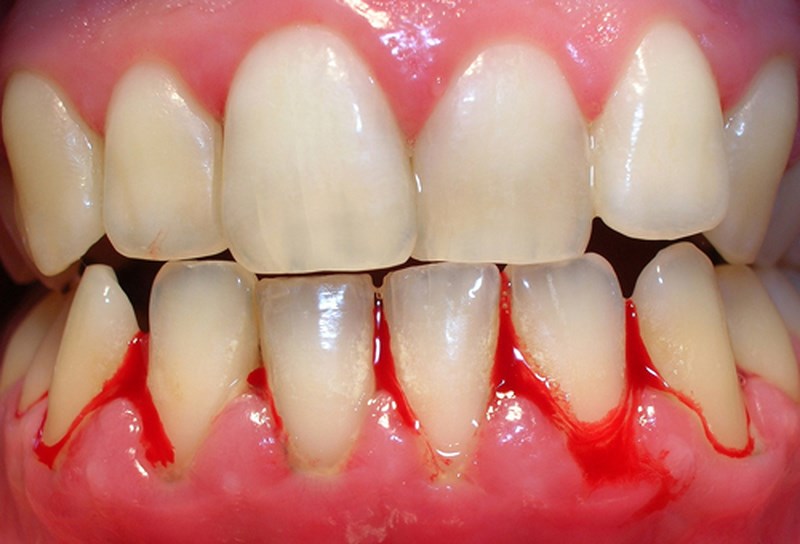 Mơ Thấy Chảy Máu Răng: Điềm Báo Hay Cảnh Báo?