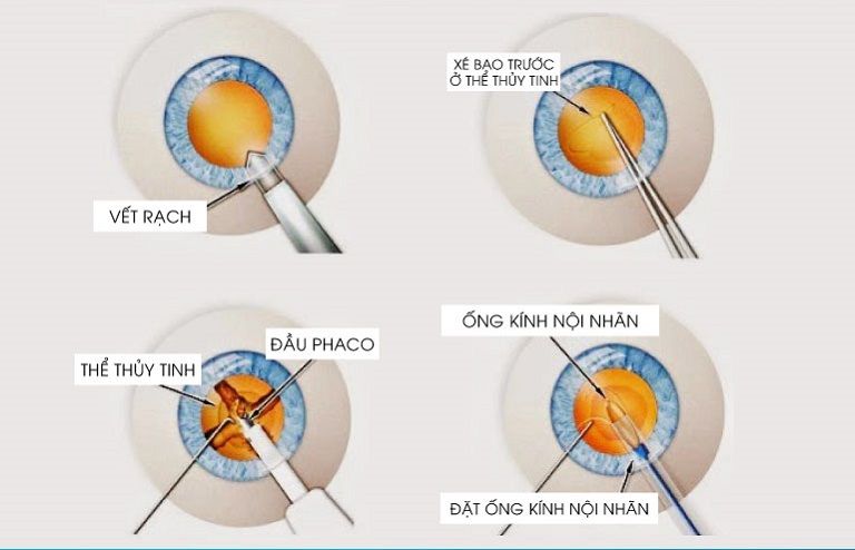 Mổ Cườm Mắt Bao Lâu? Gallery 2