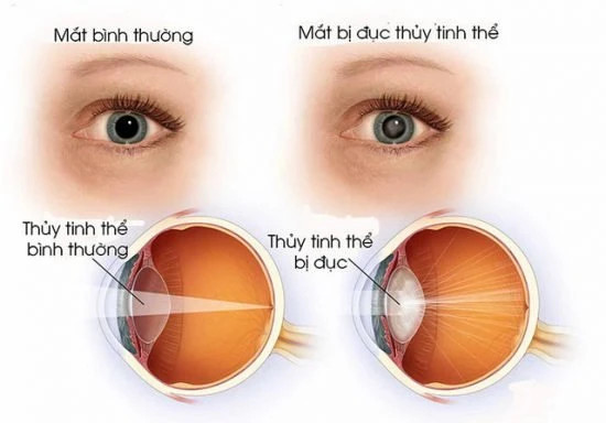Mổ cườm mắt là gì?