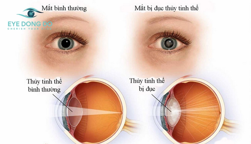 Mổ mắt cườm cần kiêng những gì?