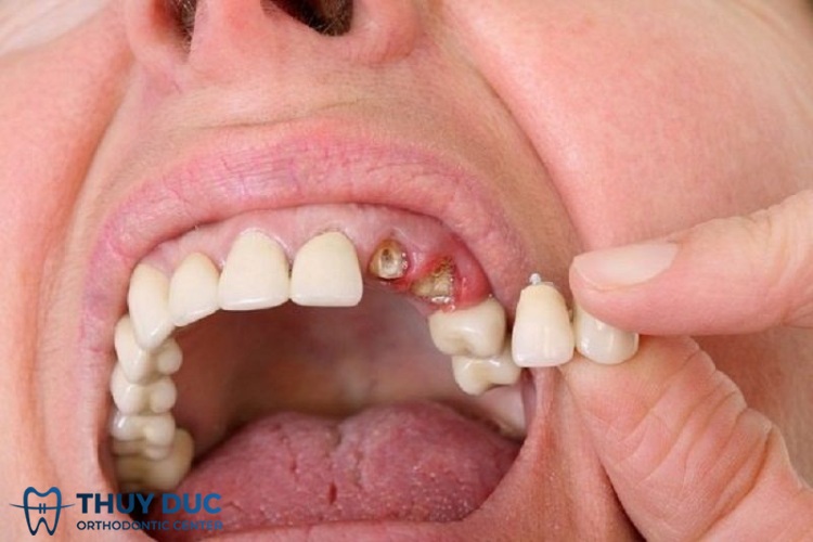 Mơ Rụng Nhiều Răng