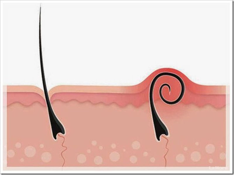 Mọc 1 Sợi Lông Ở Ngực: Nguyên Nhân Và Điều Cần Biết