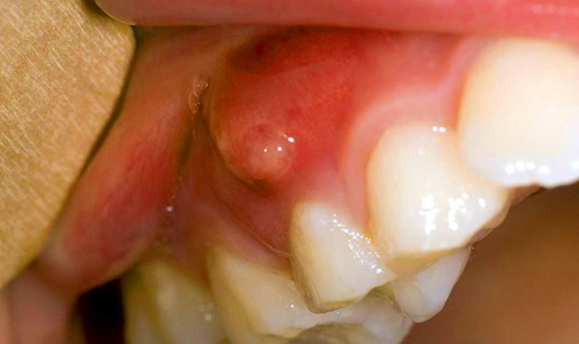 Mọc mủ ở lợi: Nguyên nhân, triệu chứng và cách điều trị