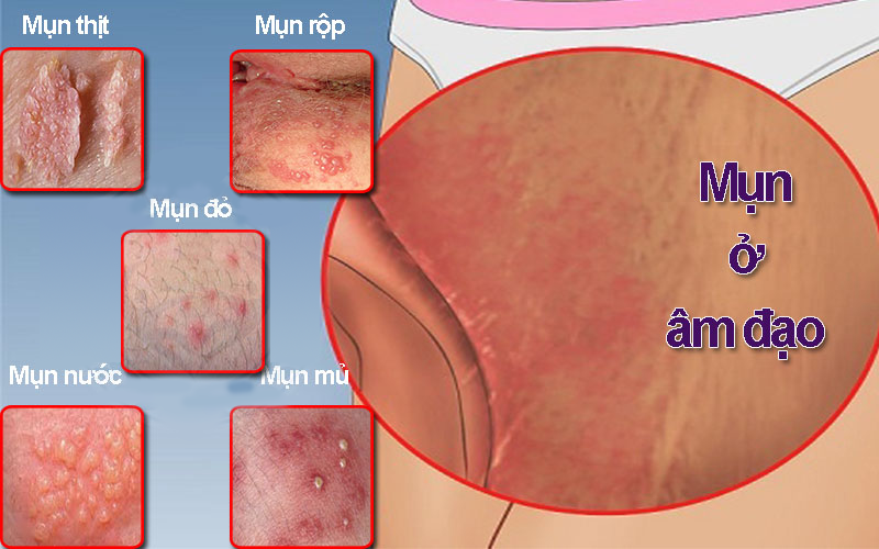Mọc Mụn Ở Âm Đạo