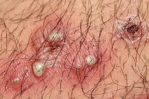 Mọc mụn ở cô bé có sao không?