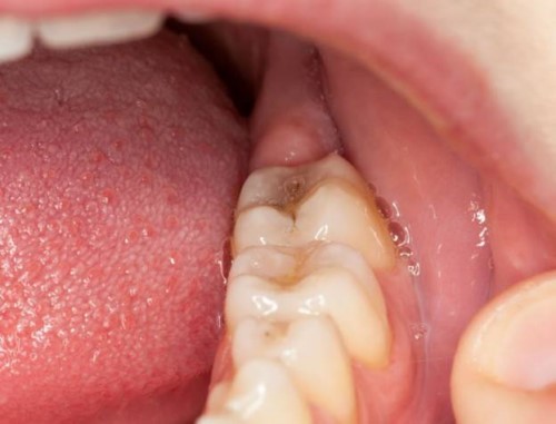Mọc Răng Cuối Cùng Hàm Dưới