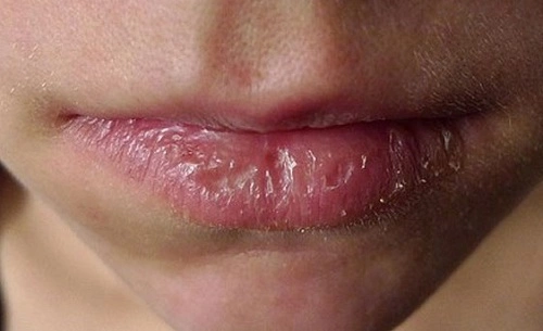 Môi bị nhiễm chì: Nguyên nhân, triệu chứng và cách điều trị