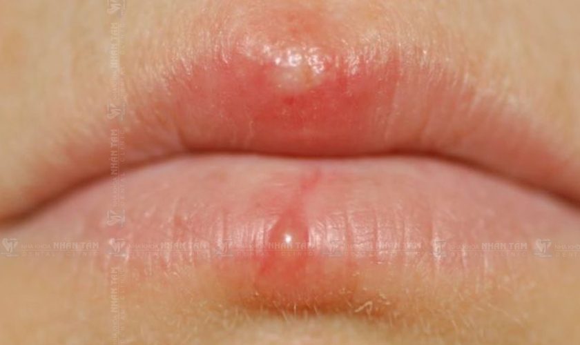 Môi Bị Nổi Bọng Nước: Nguyên Nhân, Cách Điều Trị Và Phòng Ngừa