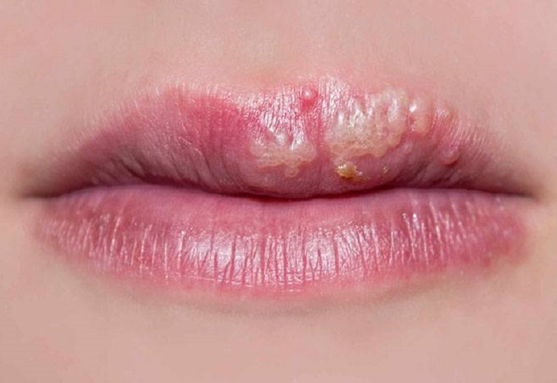 Môi Bị Rộp Nước: Nguyên Nhân, Cách Điều Trị Và Phòng Ngừa