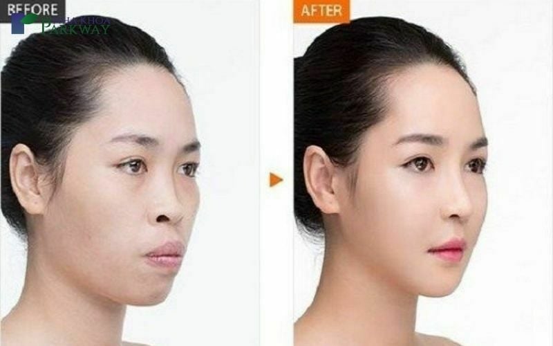 Môi dày miệng rộng