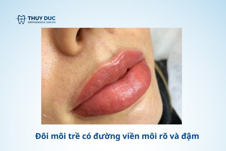 Môi dưới bị trề: Nguyên nhân, triệu chứng và cách khắc phục