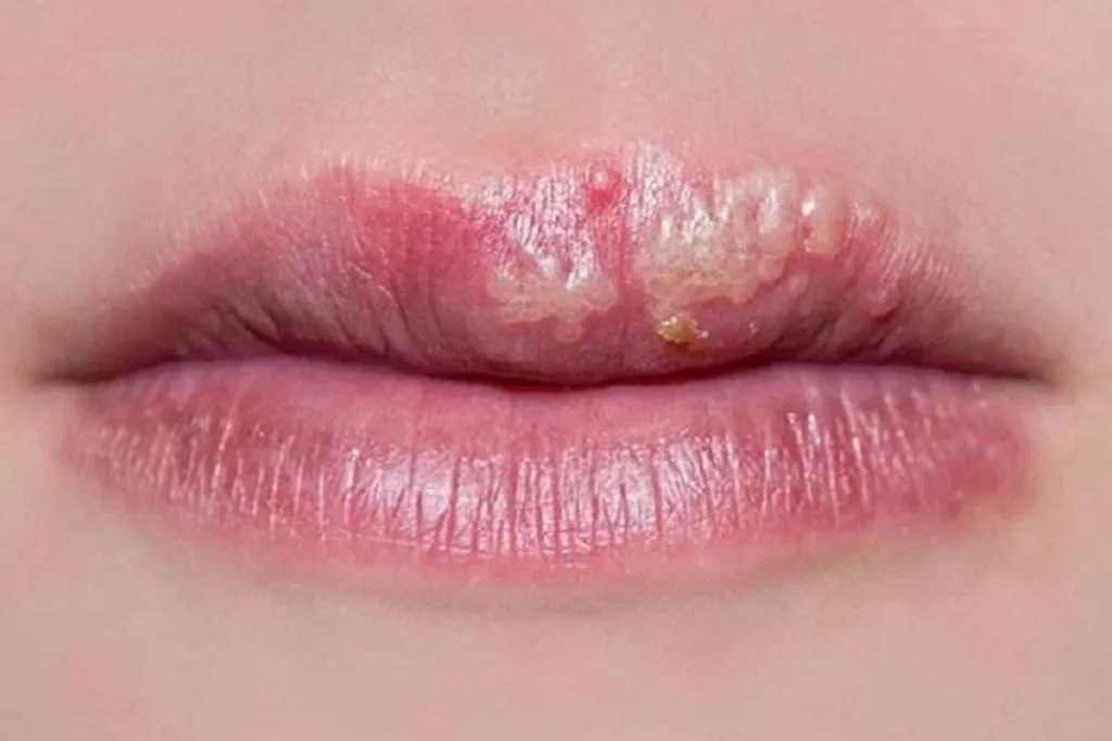 Môi nổi mụn li ti: Nguyên nhân, cách điều trị và phòng ngừa