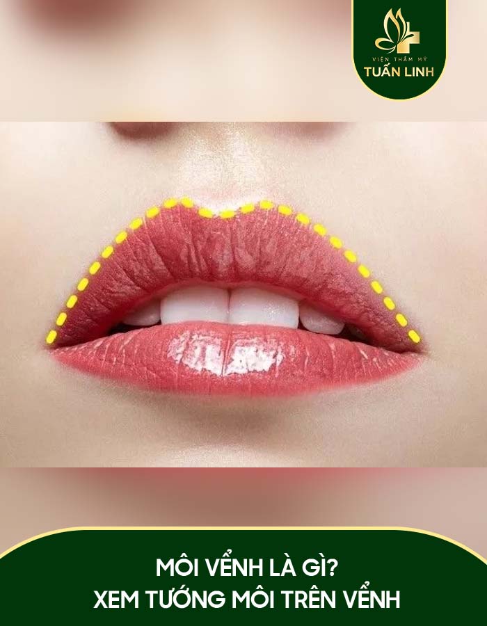 Môi Vểnh Là Gì?