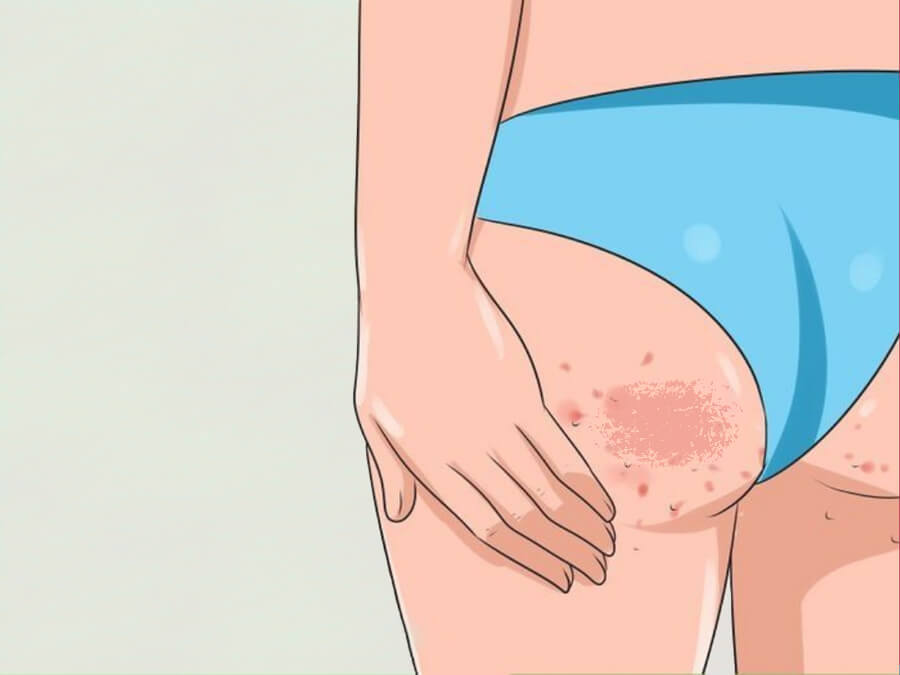 Mông Bị Chai Sần: Nguyên Nhân, Cách Điều Trị Và Phòng Ngừa