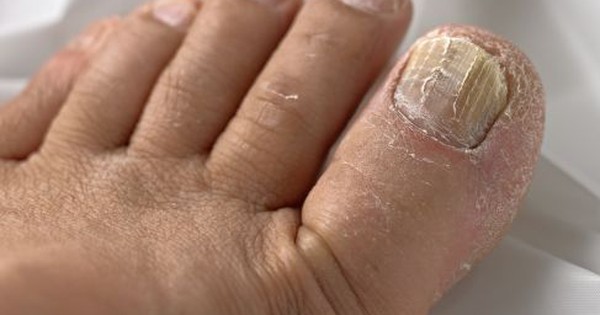 Móng Chân Bị Sần: Nguyên Nhân và Cách Khắc Phục