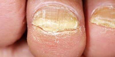 Móng Chân Bị Sần Sùi Là Thiếu Chất Gì? Gallery 2