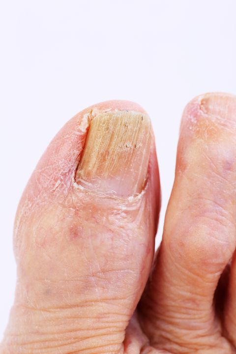 Móng Chân Bị Xỉn Màu: Nguyên Nhân và Cách Khắc Phục