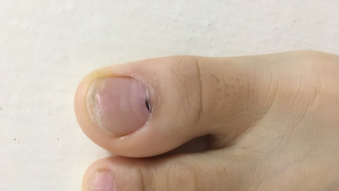 Móng Chân Có Chấm Đen Nhỏ: Nguyên Nhân Và Cách Xử Lý