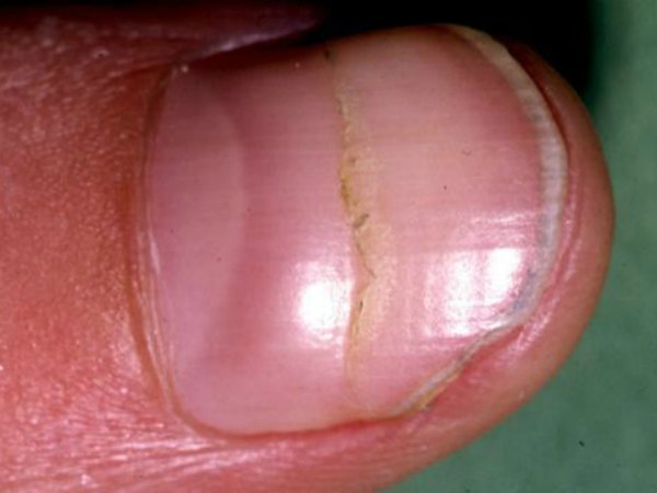 Móng Chân Có Lằn Ngang: Nguyên Nhân Và Cách Khắc Phục