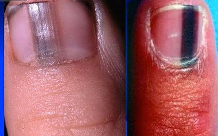 Móng Chân Có Sọc Đen: Nguyên Nhân Và Cách Xử Lý