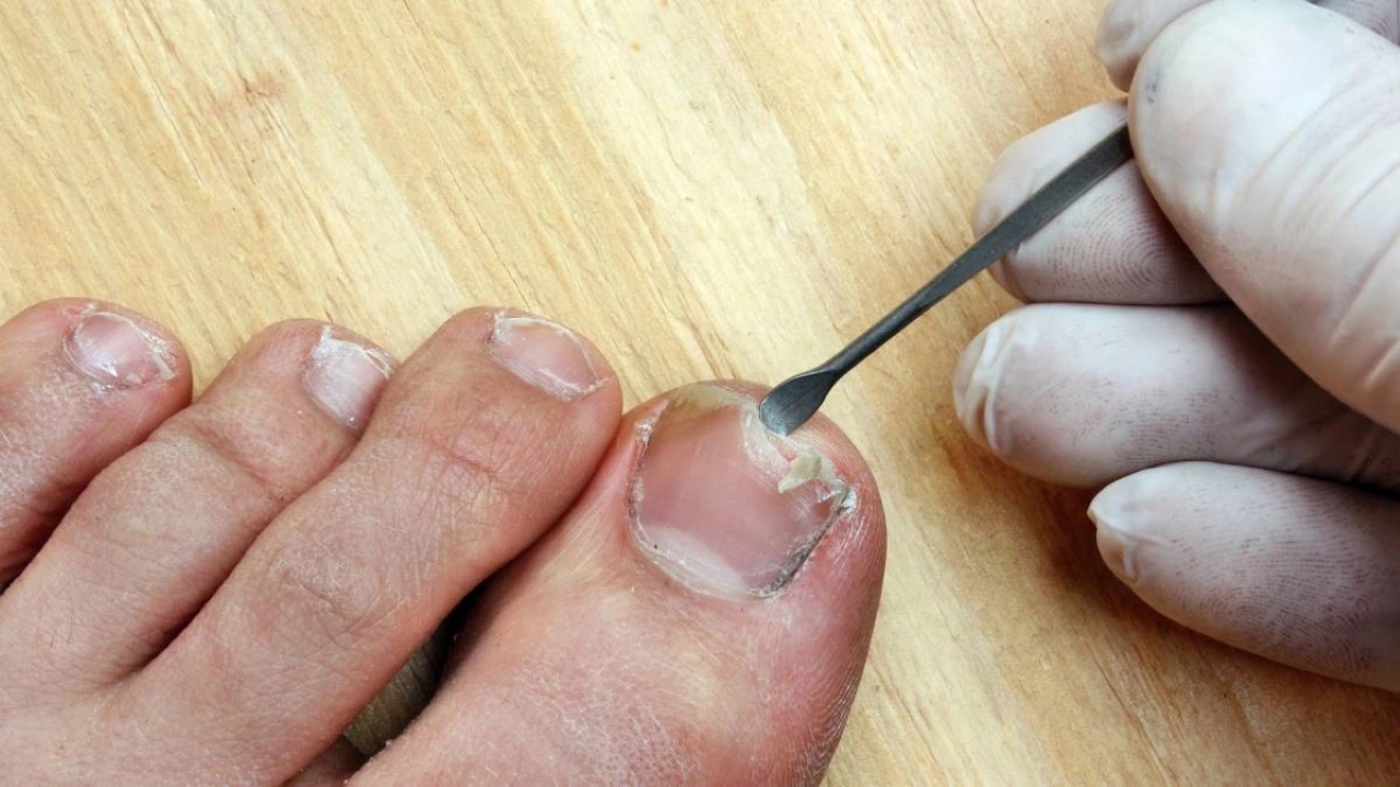 Móng Chân Trẻ Em Bị Sần Sùi: Nguyên Nhân và Cách Khắc Phục