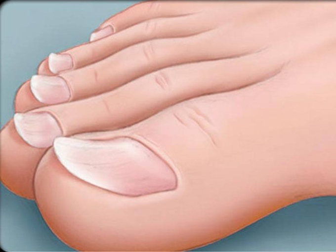 Móng Chân Vểnh Nói Lên Điều Gì?