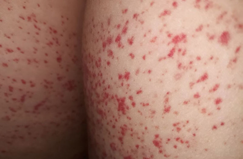 Mông nổi mẩn đỏ: Nguyên nhân và cách điều trị