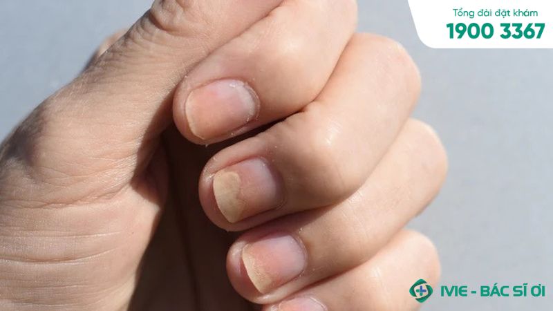 Móng Tay Bé Bị Tách Lớp: Nguyên Nhân, Cách Điều Trị Và Phòng Ngừa