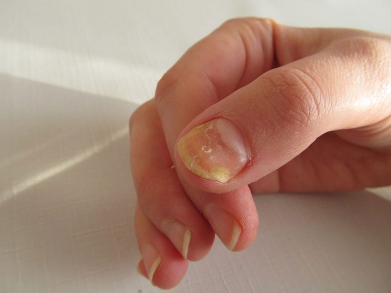 Móng Tay Bị Lõm: Nguyên Nhân Và Cách Khắc Phục