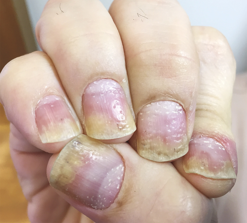 Móng Tay Bị Sần Sùi: Nguyên Nhân Và Cách Khắc Phục