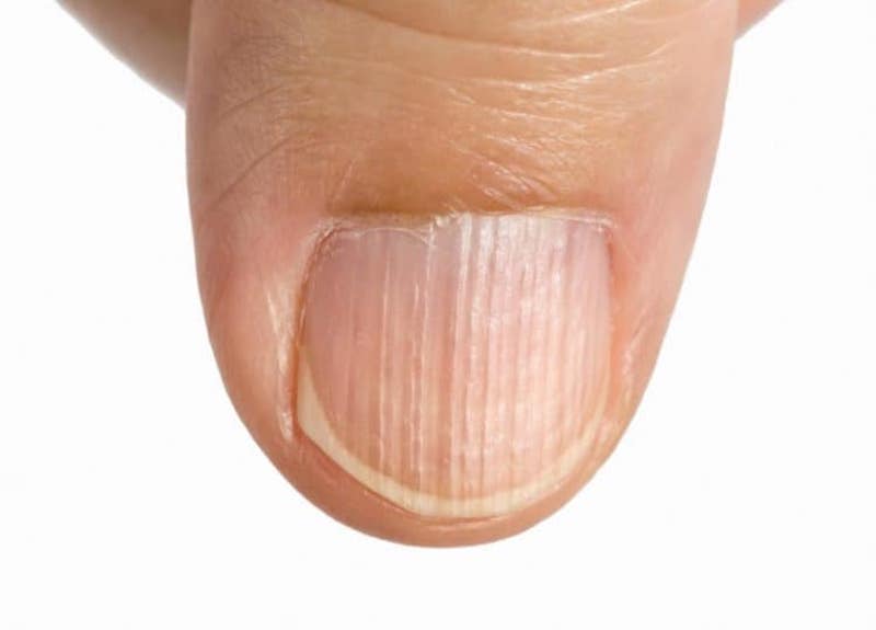 Móng Tay Có Khía: Nguyên Nhân, Cách Điều Trị và Phòng Ngừa