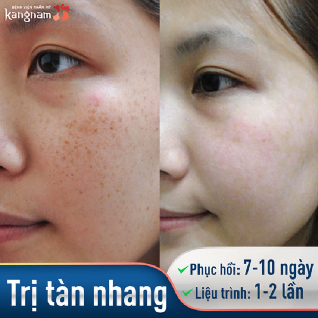 Bắn tàn nhang ở đâu? Gallery 2