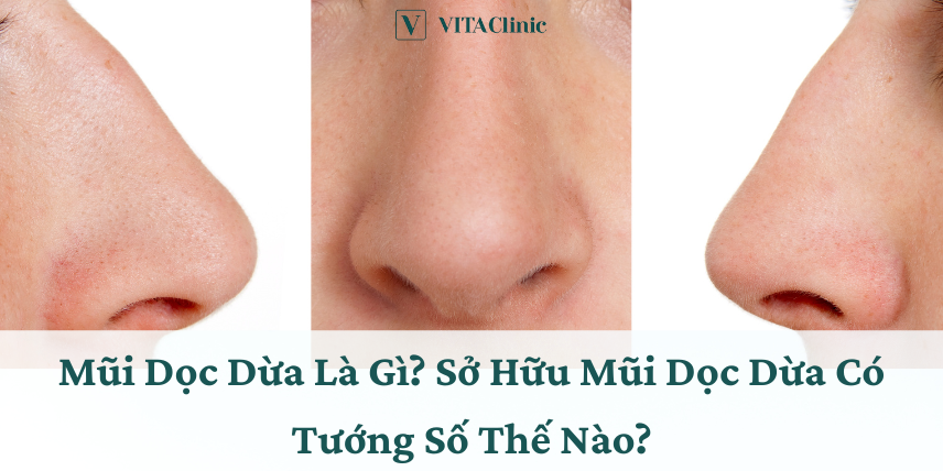 Mũi Dọc Dừa Thấp Gallery 1