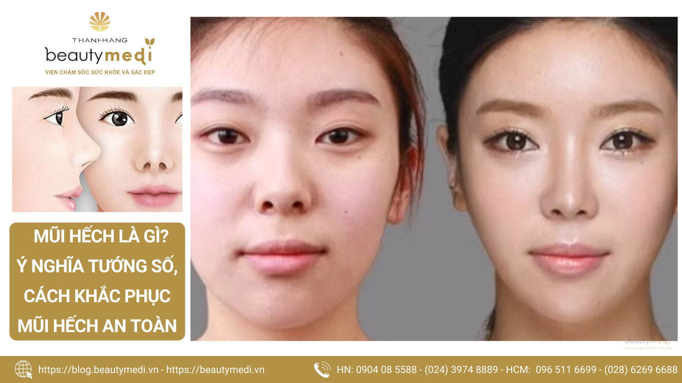 Mũi Hếch Là Gì?