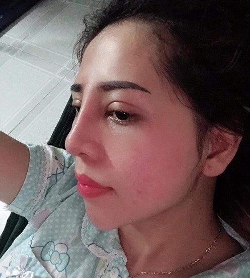Mũi mọc từ trán: Nguyên nhân và cách xử lý