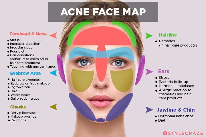 Hidden Acne: Causes, Treatment, and Prevention
