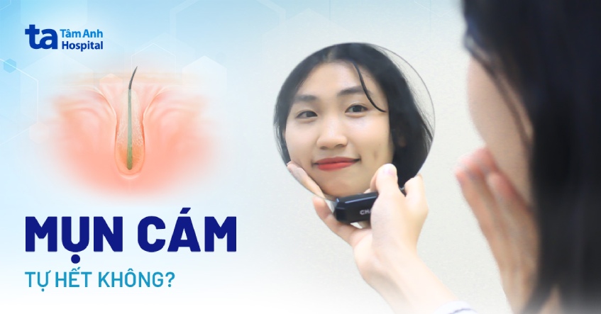 Mụn cám có tự hết được không?