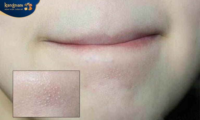 Mụn cám có tự hết được không? Gallery 2