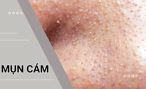 Mụn cám có tự hết được không? Gallery 1