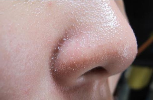 Mụn cám ở mũi làm sao hết?
