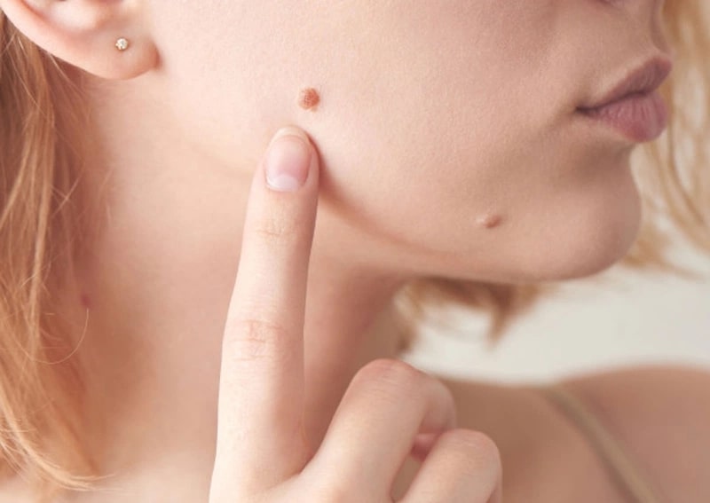 Mụn Ruồi Má Phải: Ý Nghĩa, Tướng Số và Cách Xử Lý