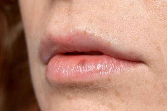 Mụn Ruồi Ở Môi Dưới: Nguyên Nhân, Ý Nghĩa Và Cách Xử Lý