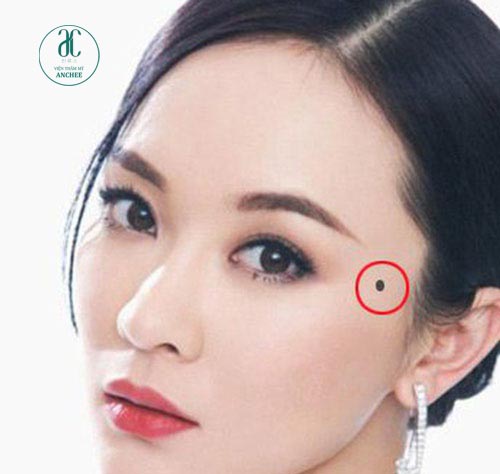 Mụn Ruồi Ở Thái Dương: Ý Nghĩa, May Mắn Hay Xui Xẻo? Gallery 2