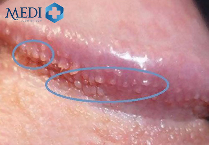 Mụn Trắng Ở Bộ Phận Sinh Dục Nam: Nguyên Nhân, Triệu Chứng Và Cách Điều Trị