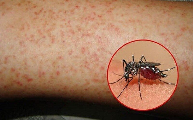 Muỗi đốt bao lâu thì bị sốt xuất huyết?