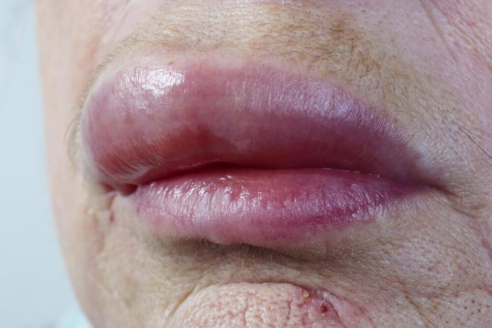 Muỗi Đốt Vào Môi: Nguyên Nhân, Triệu Chứng Và Cách Điều Trị