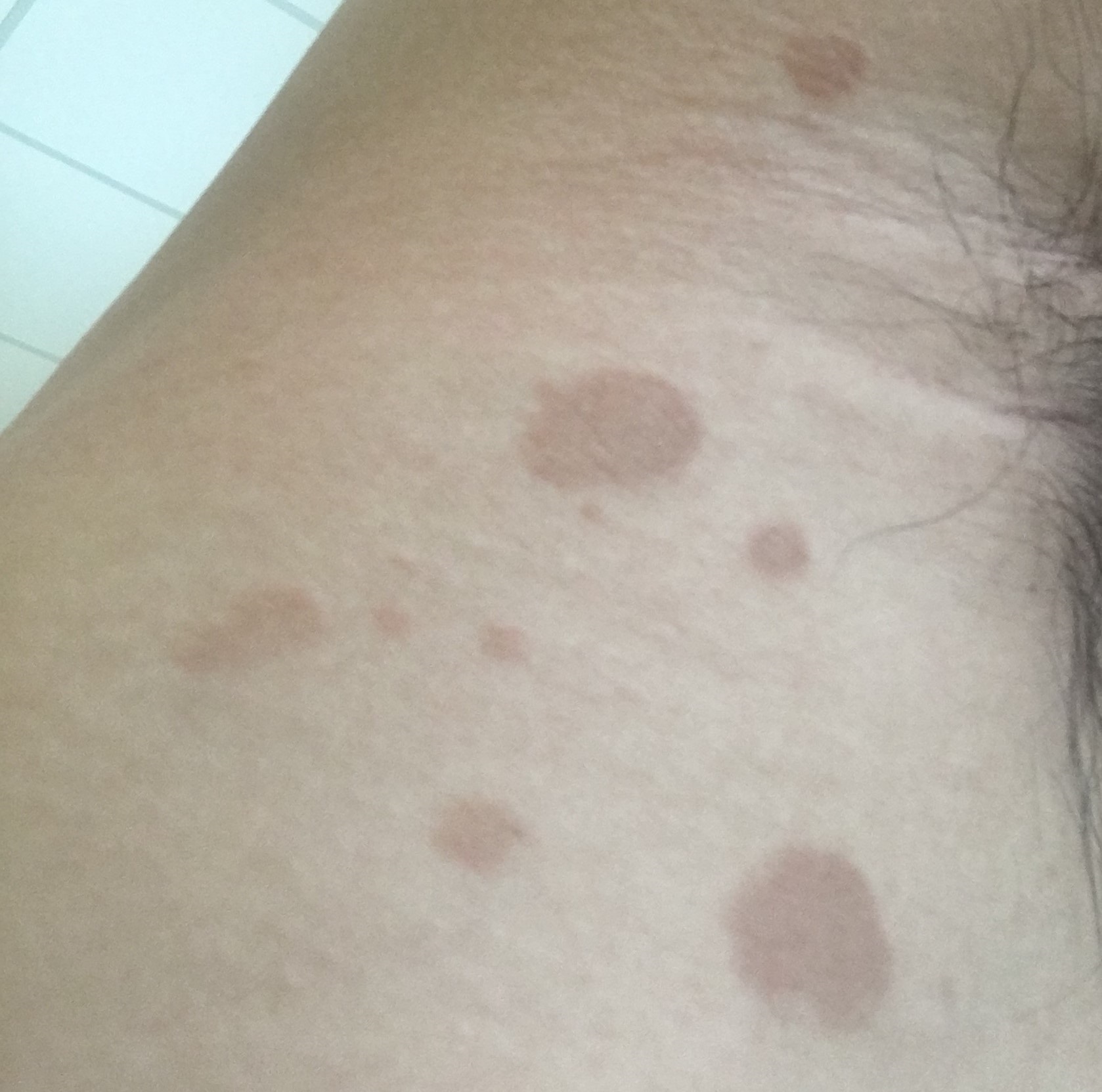 Nách bị đốm nâu: Nguyên nhân và cách điều trị hiệu quả