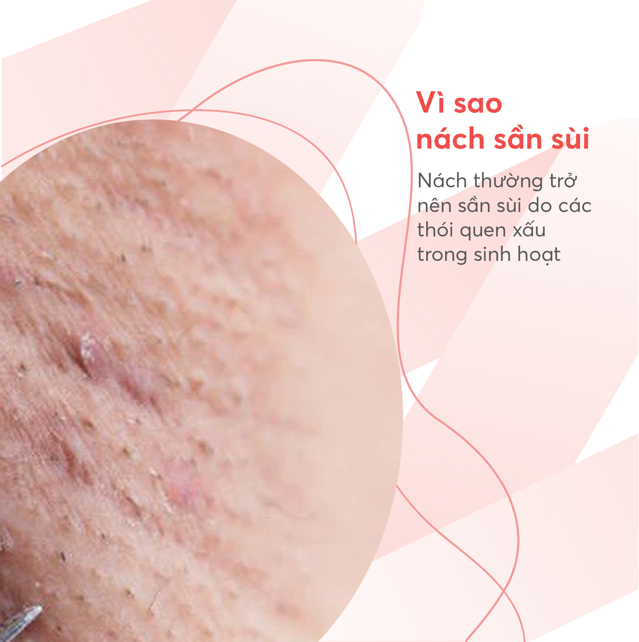 Nách bị sần sùi: Nguyên nhân và cách khắc phục